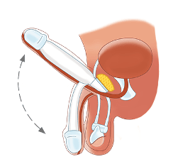 2. De hydraulische erectieprothese.png